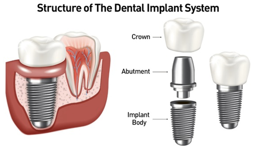dental implants in Glastonbury, CT