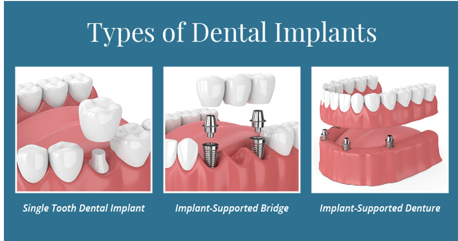 Dental implants in Glastonbury, CT